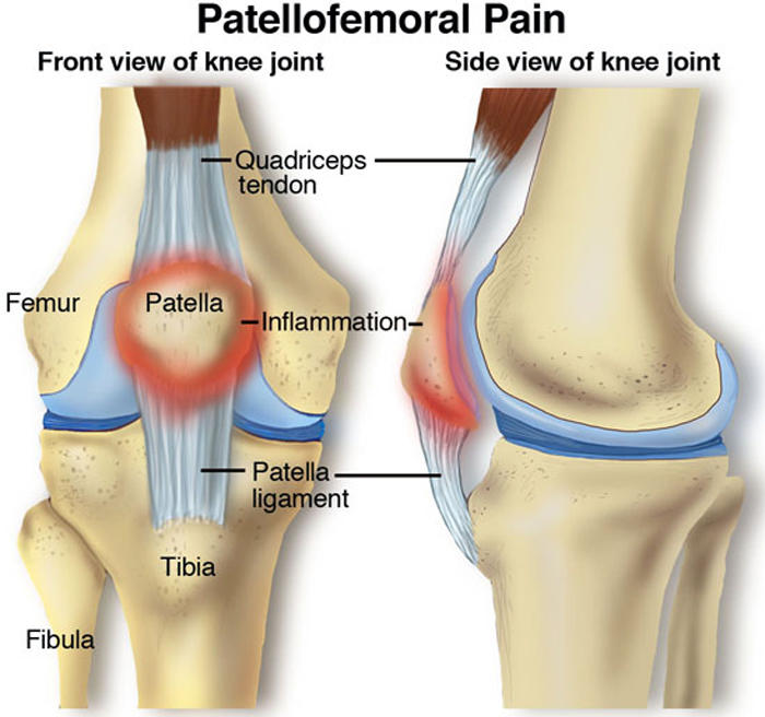 Patellofemoral pain syndrome is a broad term used to describe pain in the front of the knee and around the patella, or kneecap.