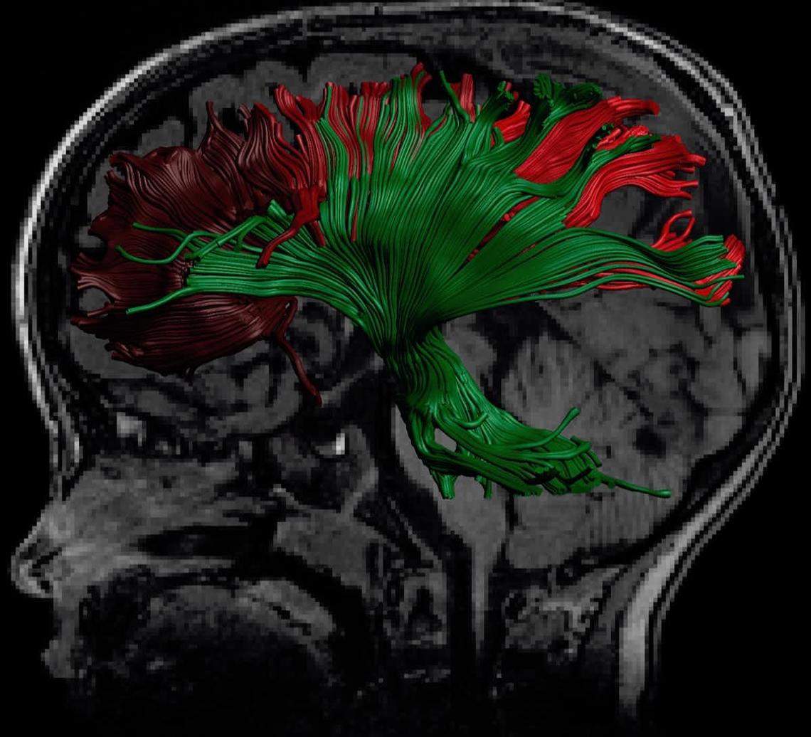 A structural MRI with an overlay of a speciality MRI, called diffusion tensor imaging, which is showing promise in detecting abnormalities after concussion. 