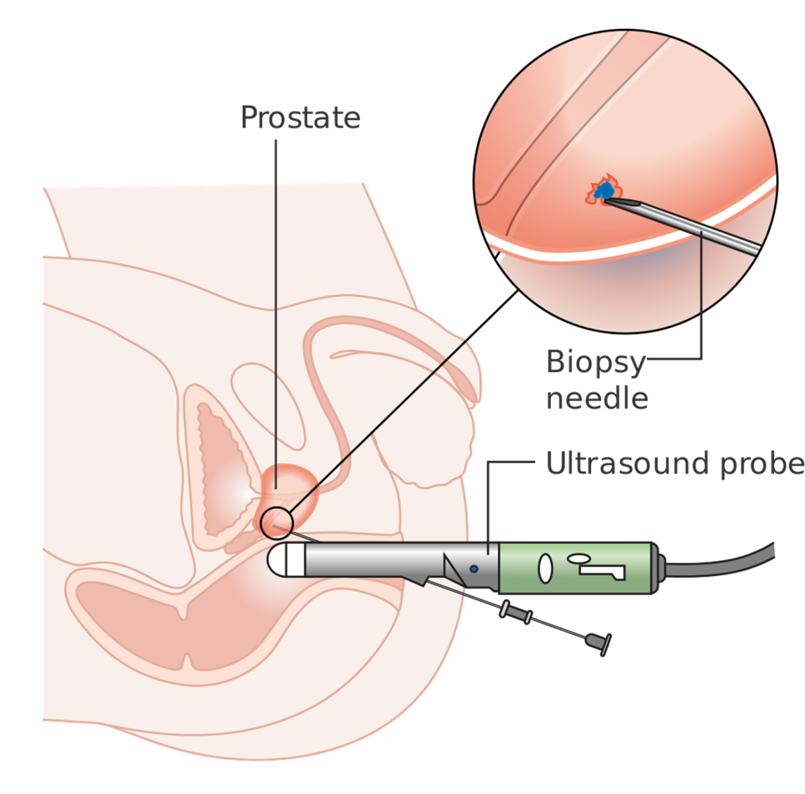 A prostate biopsy. 