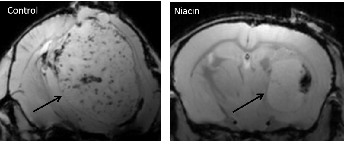 MRI shows that the huge growth capacity of glioblastoma tumor mass (arrow) within the brain in an experimental model was attenuated by niacin therapy compared to control.